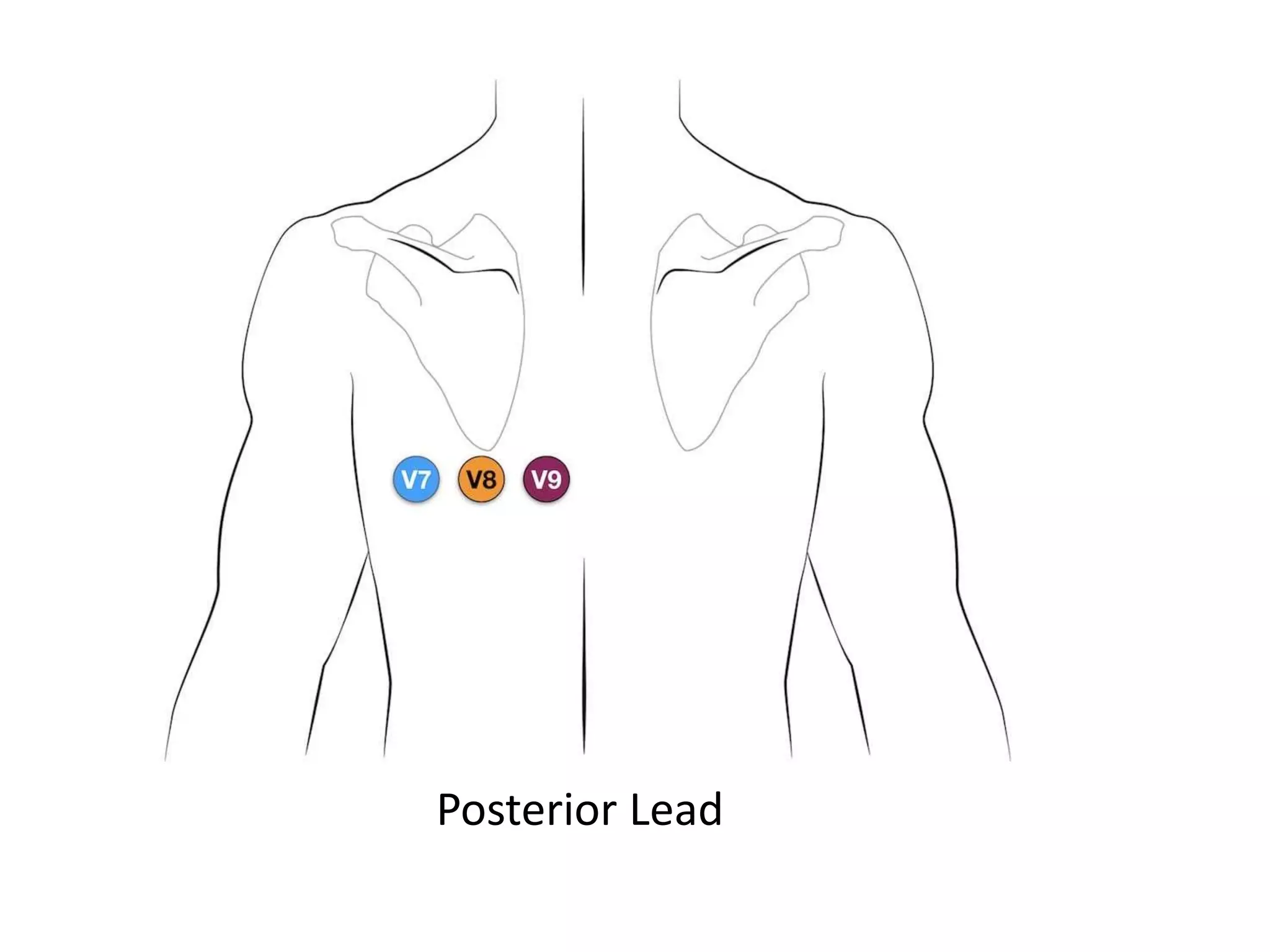 Posterior Lead
 