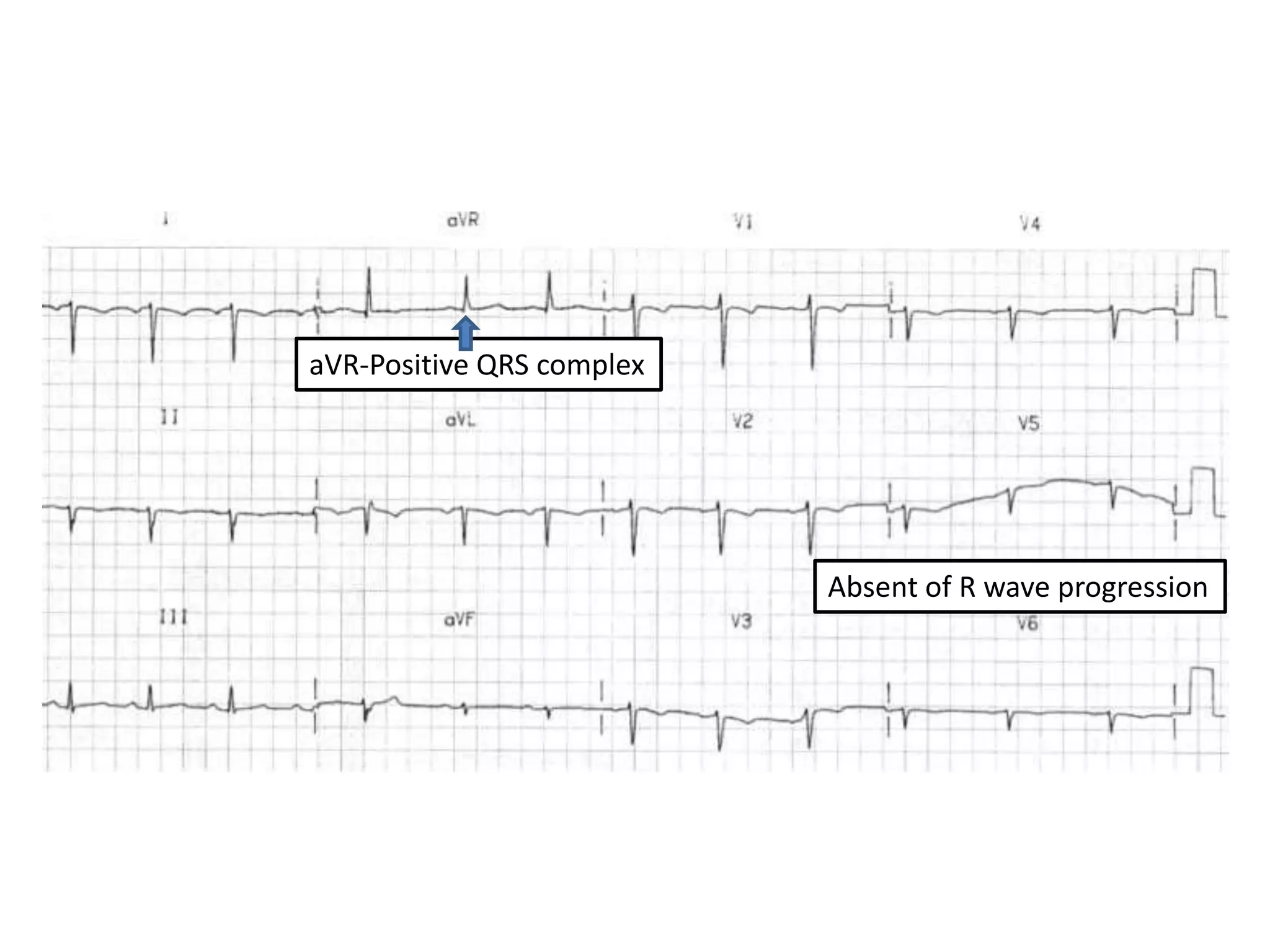 aVR-Positive QRS complex
Absent of R wave progression
 