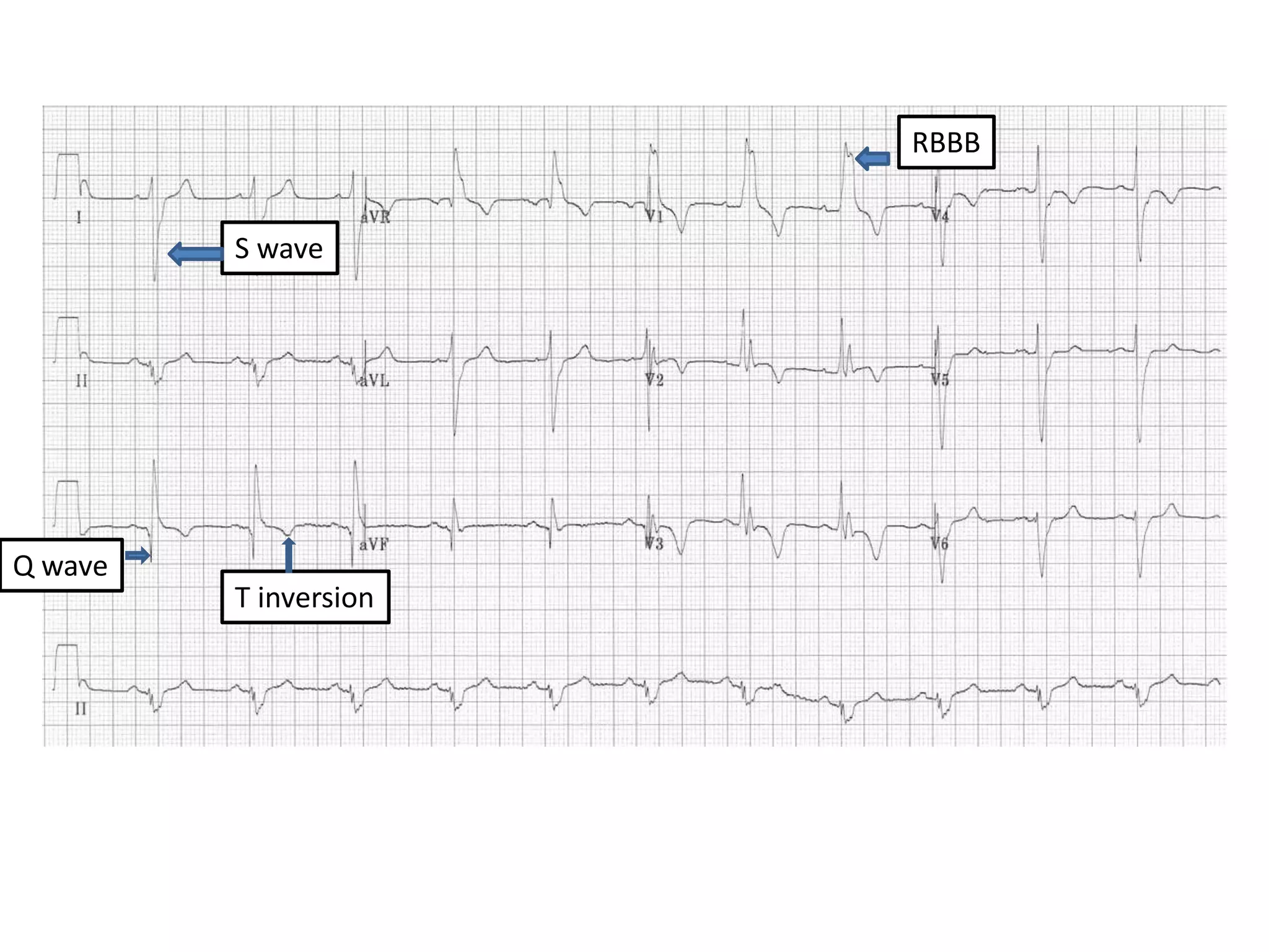 S wave
Q wave
T inversion
RBBB
 