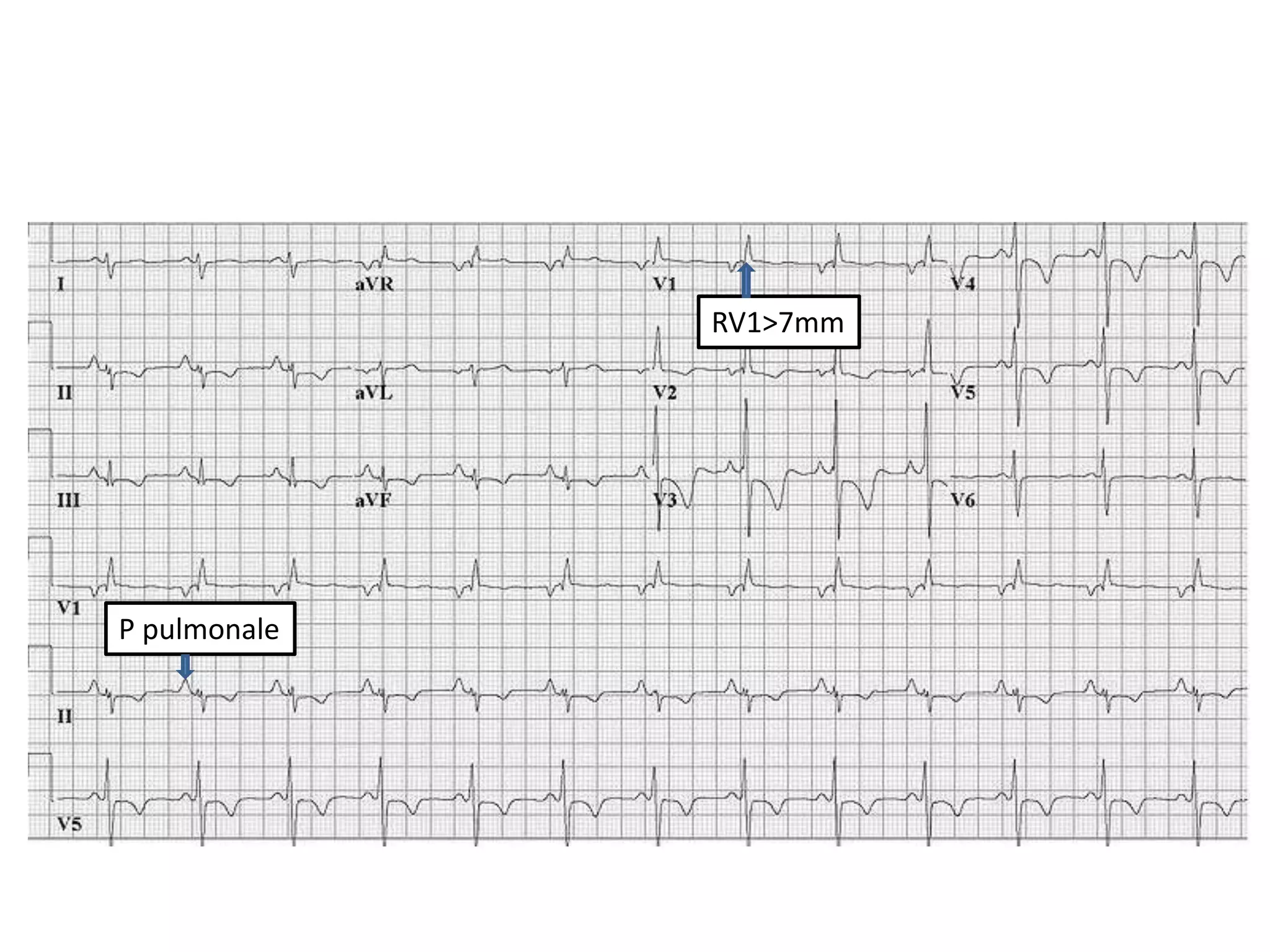P pulmonale
RV1>7mm
 