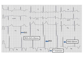 RIGHT VENTRICULAR HYPERTROPHY
• Tall R wave in V1 > 7 mm
• Right axis deviation
 