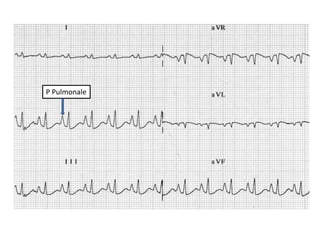 ATRIAL FIBRILLATION
• P wave Absent
• P may be replaced by fibrillary f wave
• Rhythm: Irregularly irregular
 