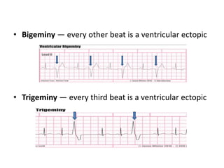 VENTRICULAR TACHYCARDIA
• P wave—absent
• QRS—broad , abnormal or bizarre pattern
• Rate > 100 beats /minute
 