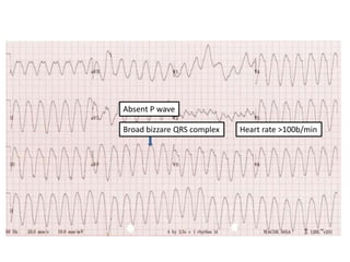 VENTRICULAR FIBRILLATION
• Chaotic irregular deflections of varying
amplitude
• No identifiable P waves, QRS complexes, or...