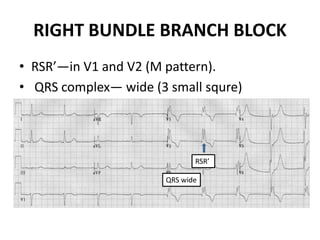 LEFT BUNDLE BRANCH BLOCK
• RSR’—in V5 and V6, also in LI and aVL (M pattern).
• QRS—wide (3 small squares)
RSR’
QRS wide
 