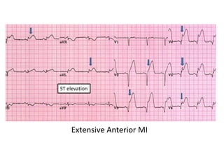 ST elevation
High lateral MI
 