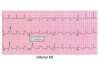 Right Ventricular Infarction
When suspect
• ST elevation in V1
• ST elevation in lead III > lead II
ST elevation L3>L2
 