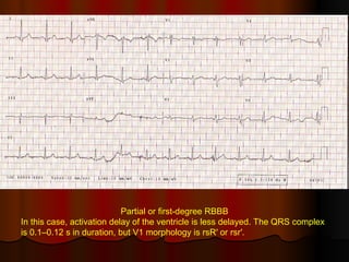 Partial Rbbb Ecg Examples Ecg 2 | PPT