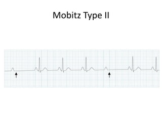 Mobitz Patterns ECG electrocardigram | PPTX