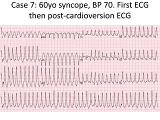 Case 7: 60yo syncope, BP 70. First ECG
then post-cardioversion ECG
 