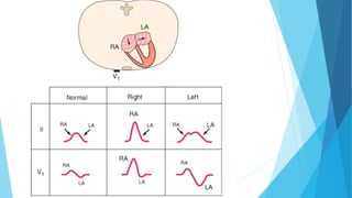 ECG - Electrocardiogram 
