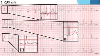 3. QRS axis
 