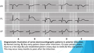 Diagrammatic illustration of serial electrocardiographic patterns in anterior infarction.
A) Normal tracing. B) Very early pattern (hours after infarction). C) Later pattern (many
hours to a few days D) Late established pattern (many days to weeks E) Very late pattern:
This may occur many months to years after the infarction.
 
