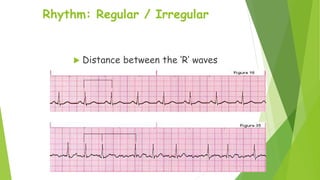 Ecg Irregular Rythm Rad ECG | PPTX
