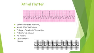 Atrial Flutter
 Ventricular rate: Variable,
 Atrial: 250-300/minute
 P shape – “sawtooth” formation
 P-R interval: Absent
 No P wave
 QRS complex:
Normal
 