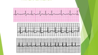Atrial Fibrillation
 