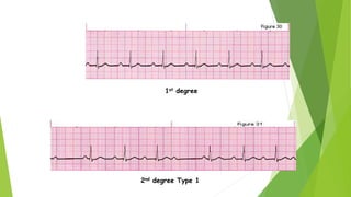 2nd degree Type 1
1st degree
 