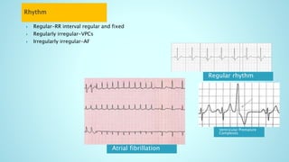 Regular rhythm
Ventricular Premature
Complexes
 Regular-RR interval regular and fixed
 Regularly irregular-VPCs
 Irregularly irregular-AF
Atrial fibrillation
 