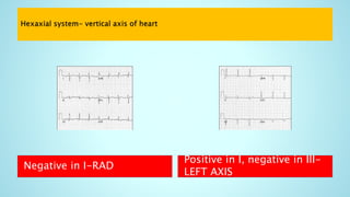 Negative in I-RAD
Positive in I, negative in III-
LEFT AXIS
 