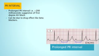 Prolonged PR interval
 Prolonged PR interval i.e. >200
milliseconds suggestive of first
degree AV block.
 Can be due to drug effect like beta
blockers.
 