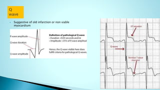  Suggestive of old infarction or non viable
myocardium
 
