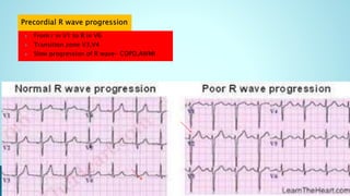  From r in V1 to R in V6
 Transition zone V3,V4
 Slow progression of R wave- COPD,AWMI
 