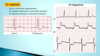  Due to ventricular repolarization.
 ST segment depression-myocardial ischemia
 ST segment elevation-myocardial infarction
 
