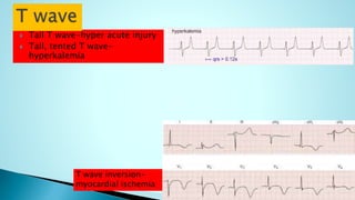  Tall T wave-hyper acute injury
 Tall, tented T wave-
hyperkalemia
T wave inversion-
myocardial ischemia
 