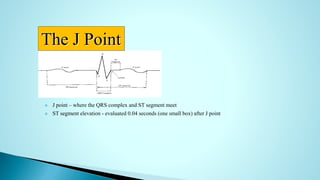  J point – where the QRS complex and ST segment meet
 ST segment elevation - evaluated 0.04 seconds (one small box) after J point
The J Point
 