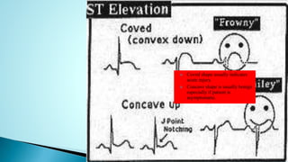  Coved shape usually indicates
acute injury.
 Concave shape is usually benign
especially if patient is
asymptomatic.
 
