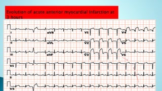 Ecg for beginners