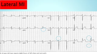 Ecg for beginners