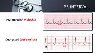 PR INTERVAL
Prolonged (A V blocks)
Depressed (pericarditis)
 