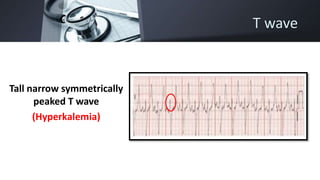 T wave
Tall narrow symmetrically
peaked T wave
(Hyperkalemia)
 