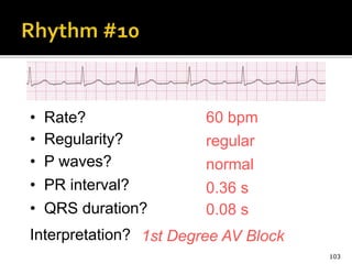103
60 bpm• Rate?
• Regularity? regular
normal
0.08 s
• P waves?
• PR interval? 0.36 s
• QRS duration?
Interpretation? 1st Degree AV Block
 
