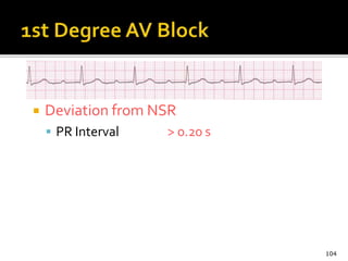  Deviation from NSR
 PR Interval > 0.20 s
104
 
