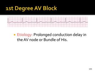  Etiology: Prolonged conduction delay in
the AV node or Bundle of His.
105
 