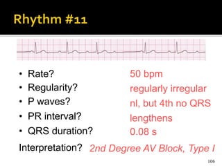 106
50 bpm• Rate?
• Regularity? regularly irregular
nl, but 4th no QRS
0.08 s
• P waves?
• PR interval? lengthens
• QRS duration?
Interpretation? 2nd Degree AV Block, Type I
 