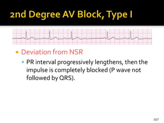  Deviation from NSR
 PR interval progressively lengthens, then the
impulse is completely blocked (P wave not
followed by QRS).
107
 