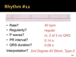 109
40 bpm• Rate?
• Regularity? regular
nl, 2 of 3 no QRS
0.08 s
• P waves?
• PR interval? 0.14 s
• QRS duration?
Interpretation? 2nd Degree AV Block, Type II
 