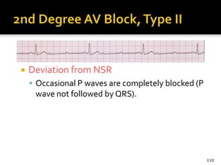  Deviation from NSR
 Occasional P waves are completely blocked (P
wave not followed by QRS).
110
 