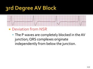  Deviation from NSR
 The P waves are completely blocked in theAV
junction; QRS complexes originate
independently from below the junction.
112
 