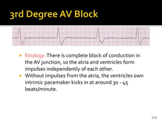  Etiology:There is complete block of conduction in
the AV junction, so the atria and ventricles form
impulses independently of each other.
 Without impulses from the atria, the ventricles own
intrinsic pacemaker kicks in at around 30 - 45
beats/minute.
113
 