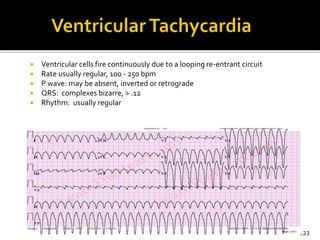  Ventricular cells fire continuously due to a looping re-entrant circuit
 Rate usually regular, 100 - 250 bpm
 P wave: may be absent, inverted or retrograde
 QRS: complexes bizarre, > .12
 Rhythm: usually regular
123
 