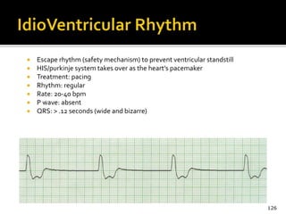  Escape rhythm (safety mechanism) to prevent ventricular standstill
 HIS/purkinje system takes over as the heart’s pacemaker
 Treatment: pacing
 Rhythm: regular
 Rate: 20-40 bpm
 P wave: absent
 QRS: > .12 seconds (wide and bizarre)
126
 
