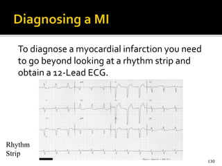 To diagnose a myocardial infarction you need
to go beyond looking at a rhythm strip and
obtain a 12-Lead ECG.
130
Rhythm
Strip
 