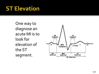 One way to
diagnose an
acute MI is to
look for
elevation of
the ST
segment.
134
 