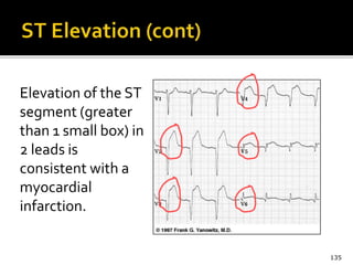 Elevation of the ST
segment (greater
than 1 small box) in
2 leads is
consistent with a
myocardial
infarction.
135
 