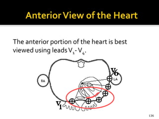 The anterior portion of the heart is best
viewed using leadsV1-V4.
136
 