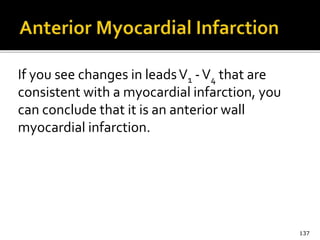 If you see changes in leadsV1 -V4 that are
consistent with a myocardial infarction, you
can conclude that it is an anterior wall
myocardial infarction.
137
 